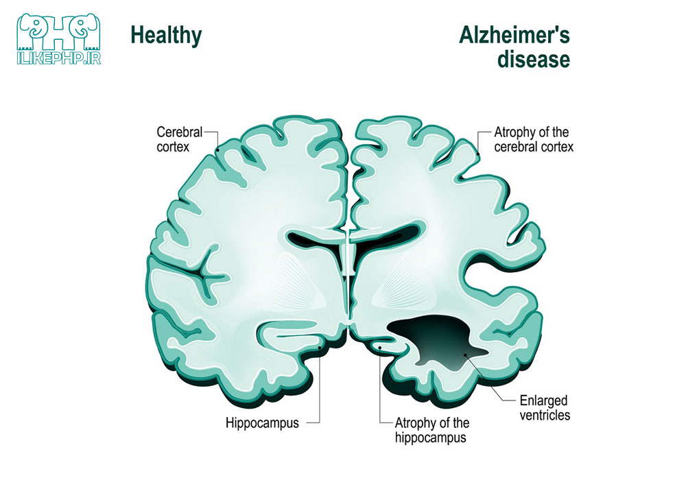 تفاوت مغز سالم با مغز مبتلا به آلزایمر