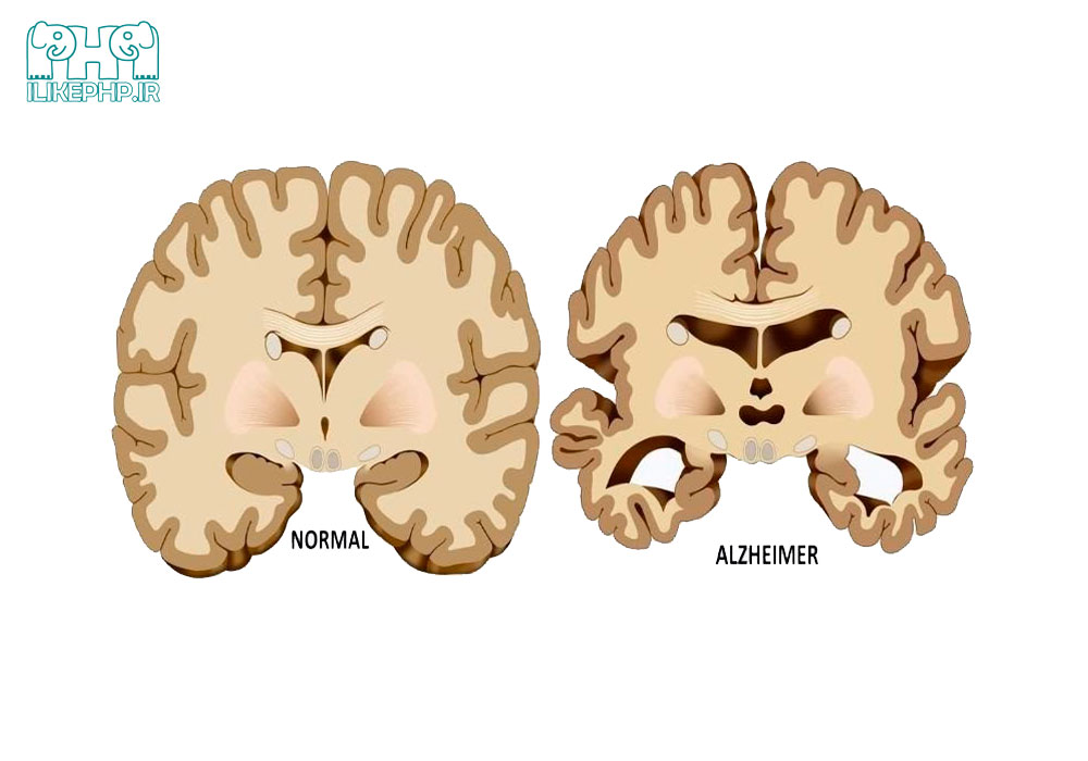 تفاوت در مغز سالم با مغز مبتلا به آلزایمر